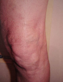 After varicose treatment After varicose treatment