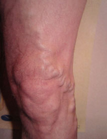 Before varicose treatment Before varicose treatment
