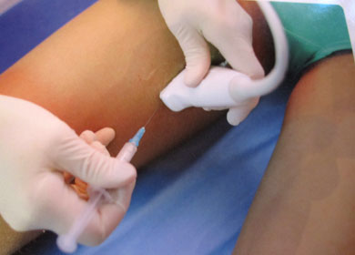 varicose treatment varicose treatment