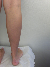 After varicose treatment After varicose treatment