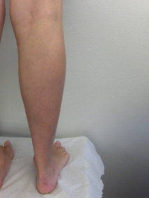 After varicose treatment