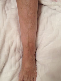 After varicose treatment After varicose treatment
