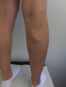 Before varicose treatment Before varicose treatment
