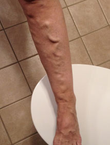 Before varicose treatment Before varicose treatment